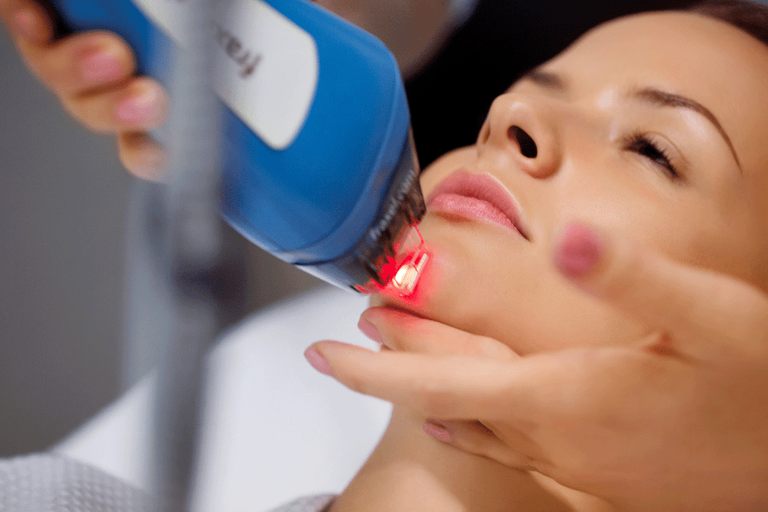 ringiovanimento della pelle del viso laser