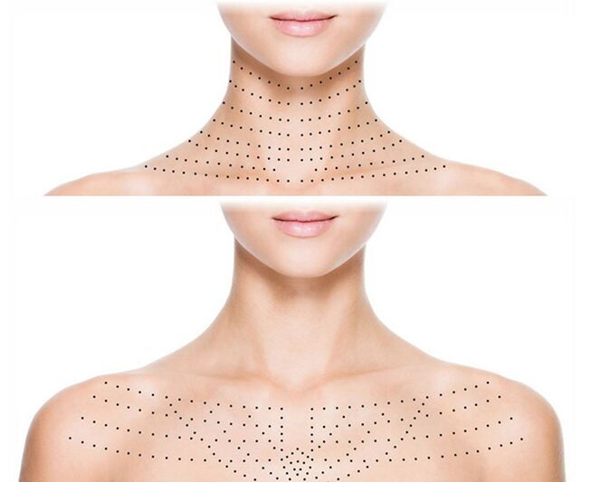 Marcatura sulla pelle del collo e del décolleté per una biorivitalizzazione ringiovanente