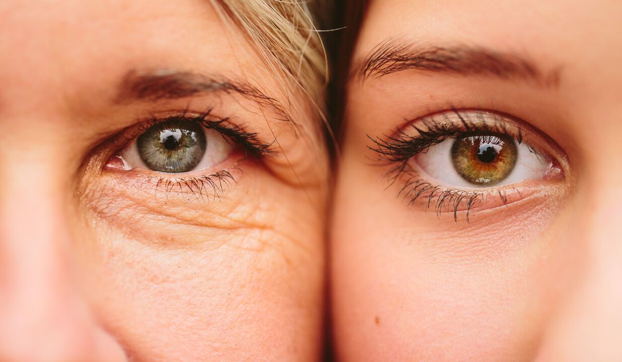 segni dell'invecchiamento intorno agli occhi