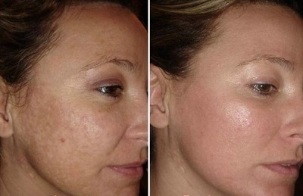 ringiovanimento della pelle del viso laser prima e dopo le foto